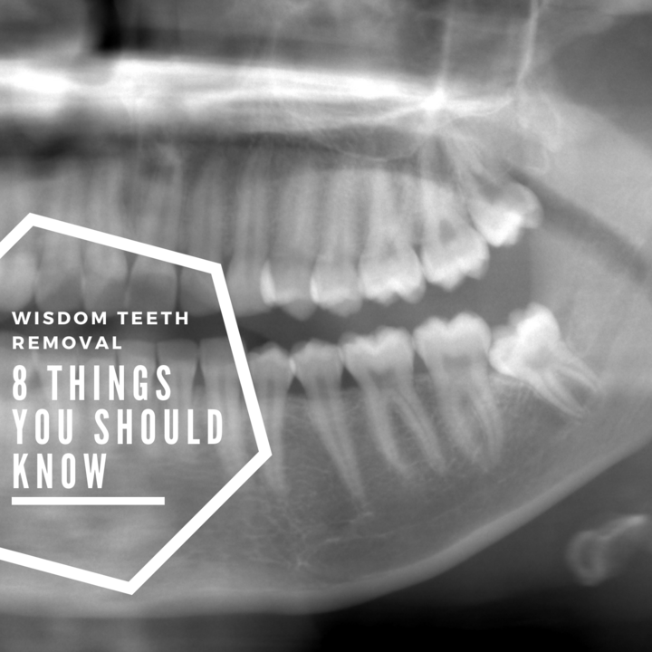 8 things to know about wisdom teeth extractions...