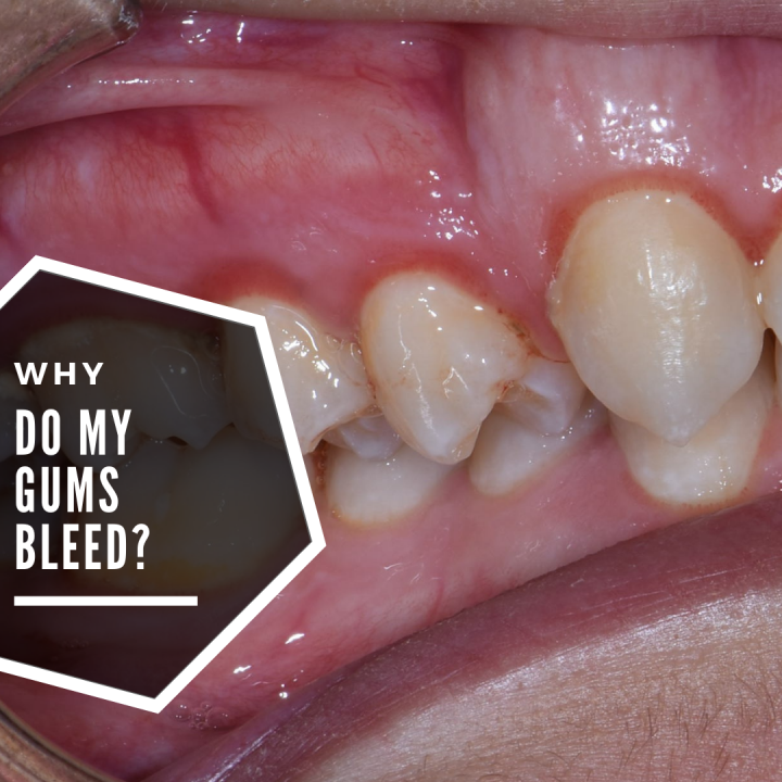 Do you have bleeding gums?