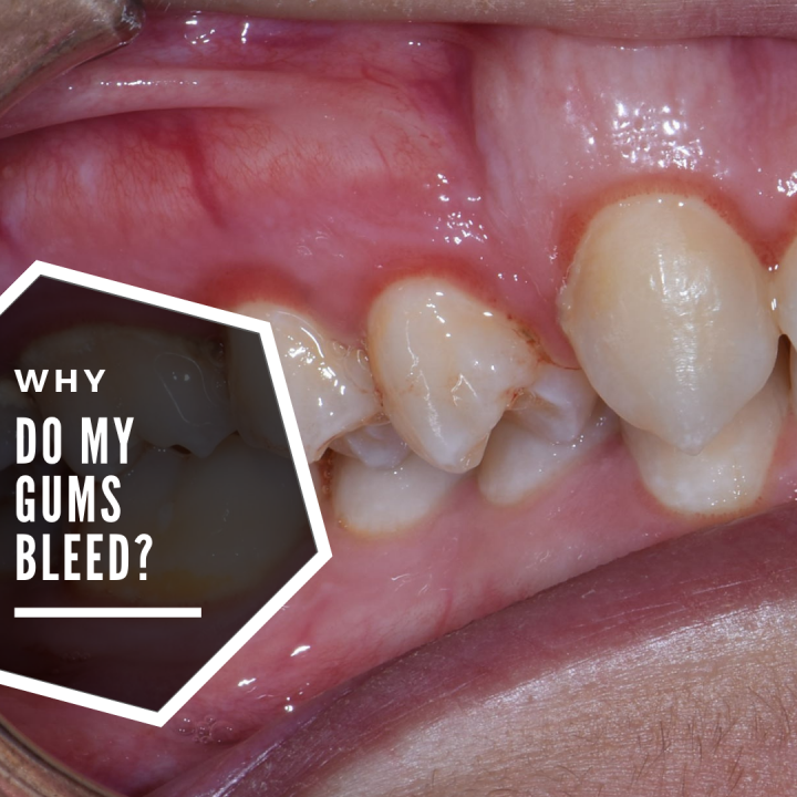 do-you-have-bleeding-gums